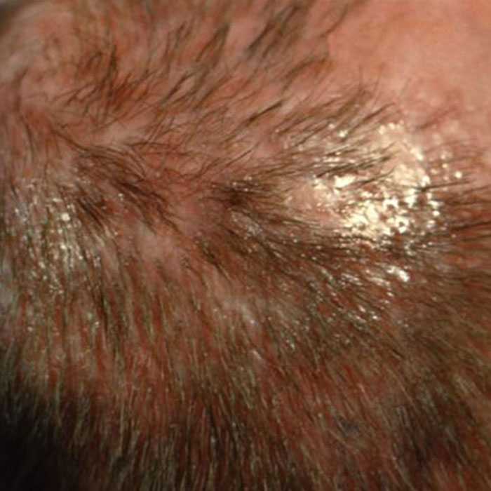 Pityriasis Amiantacea